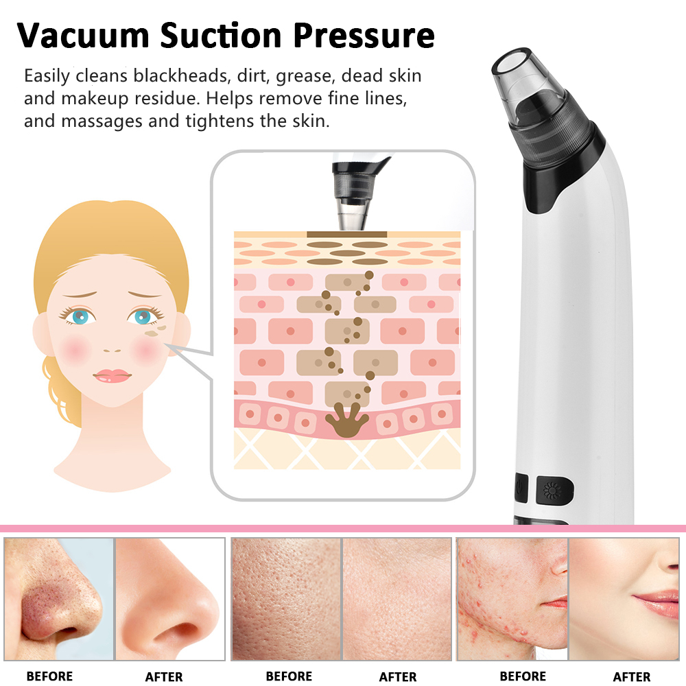 Electric Cleaning Blackhead Remover